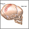 Infant skull fracture