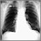 Pulmonary nodule - front view chest X-ray