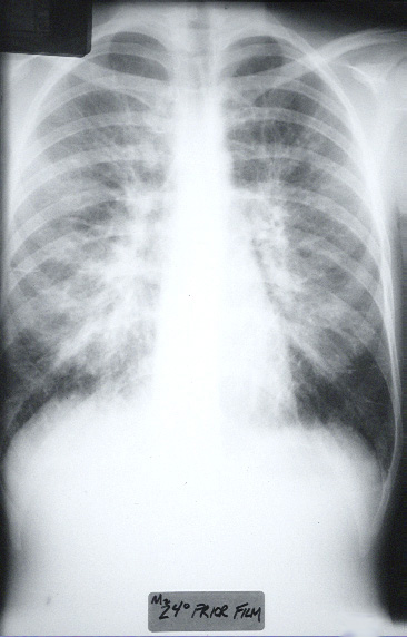 x-ray view of Kerley B lines in HPS