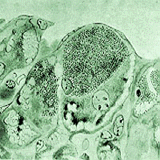 picture of tularemia