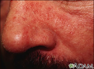 Dermatitis, seborrheic - close-up