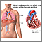 Cardiomiopatía dilatada