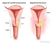 Stage II cervical cancer; drawing shows a cross-section of the uterus, cervix and vagina. In stages IIA1 and IIA2, cancer that is 4 cm is shown in the cervix and in the upper third of the vagina. In stage IIB, cancer is shown in the cervix, the upper two thirds of the vagina, and in the tissues around the uterus.