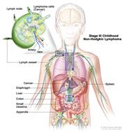 Stage III childhood non-Hodgkin lymphoma; drawing shows cancer in lymph node groups above and below the diaphragm, in the chest, and throughout the abdomen in the liver, spleen, small intestines, and appendix. The colon is also shown. An inset shows a lymph node with a lymph vessel, an artery, and a vein. Lymphoma cells containing cancer are shown in the lymph node.