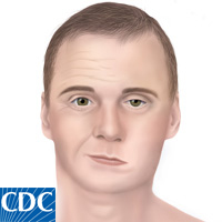 medical illustration of Bell's Palsy