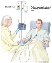 Drawing of a health care provider giving a patient treatment to kill blood-forming cells. Chemotherapy is given to the patient through a catheter in the chest.