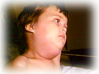 Boy with mumps.