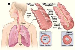 graphic of What is Asthma