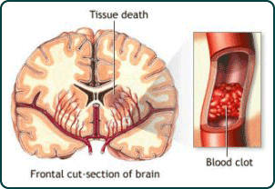 Illustration of tissue death in the frontal cut-section of the brain, as well as a blood clot that caused the damage.