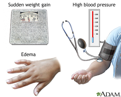 Preeclampsia