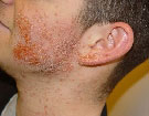 MRSA skin infection on the right side of a man's face