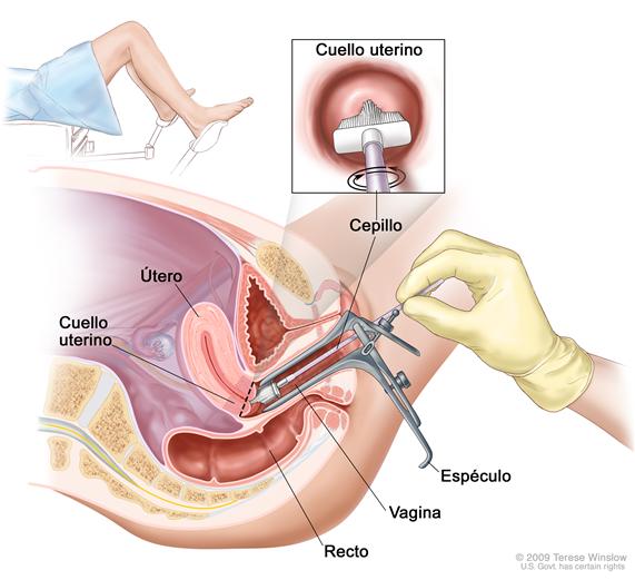 Frotis de Pap; la imagen muestra una vista de costado de la anatomía del aparato reproductor femenino durante una prueba de Pap. Se observa un espéculo que ensancha la abertura de la vagina. Se ve un cepillo que se introdujo en la vagina abierta y está tocando el cuello uterino en la base del útero. También se puede ver el recto. En un recuadro, se observa el cepillo tocando el centro del cuello uterino. En otro recuadro, se observa a una mujer cubierta por un paño en una camilla con las piernas separadas y sus pies colocados en estribos.