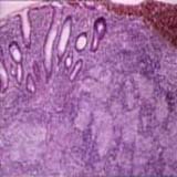 Mycobacterium tuberculosis