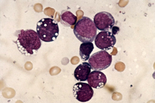 Microscope image of round Burkitt lymphoma cells.
