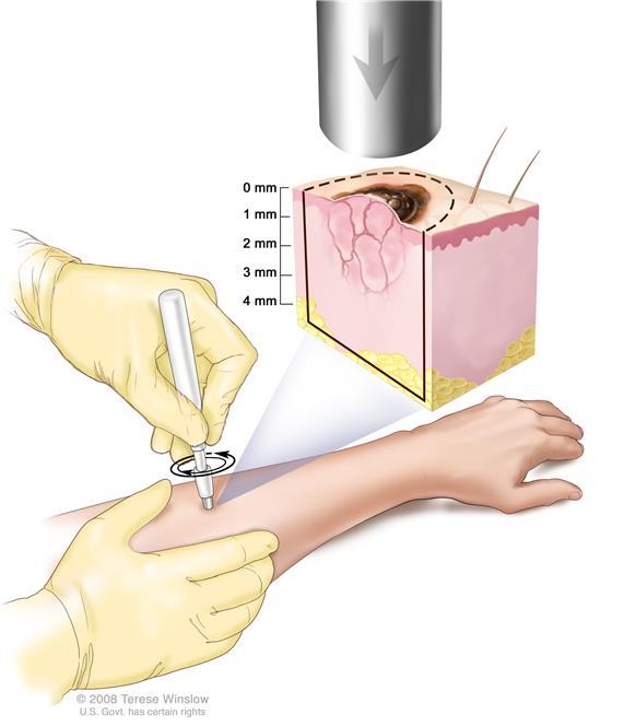 Punch biopsy; drawing shows a hollow, circular scalpel being inserted into a lesion on the skin of a patient’s forearm. The instrument is turned clockwise and counterclockwise to cut into the skin and a small sample of tissue is removed to be checked under a microscope. The pullout shows that the instrument cuts down about 4 millimeters (mm) to the layer of fatty tissue below the dermis.