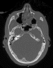 Specimen from the Visible Human Male - Head subset