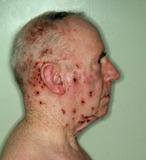 Healing sores on one side of the face. - Click to enlarge in new window.