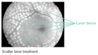 Scatter laser treatment - Click to enlarge in new window.