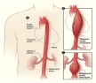 Aeortic Aneurysm Fact Sheet