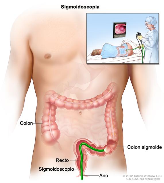 Sigmoidoscopia; muestra un sigmoidoscopio que se inserta a través del ano y el recto hacia el colon sigmoide.  El recuadro interior muestra la imagen de un paciente en camilla al que se le realiza una sigmoidoscopía.