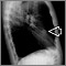 Nódulo pulmonar, lóbulo medio derecho- Radiografía de tórax