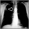 Masa pulmonar, pulmón superior derecho - Radiografía de tórax