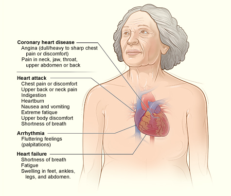 The illustration shows the major signs and symptoms of coronary heart disease.