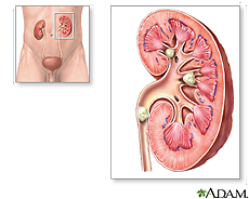 Illustration of kidney stones in the calyces and ureter