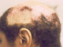 detailed image of folliculitis decalvans