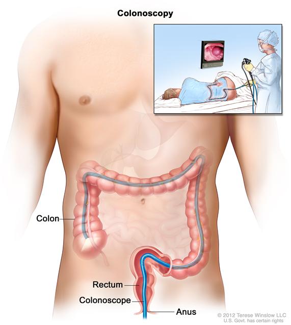 Colonoscopy; shows colonoscope inserted through the anus and rectum and into the colon.  Inset shows patient on table having a colonoscopy.