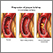 Progressive build-up of plaque in coronary artery