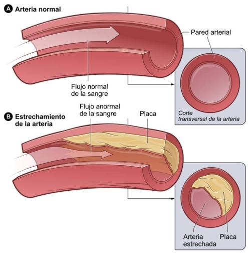 ateroesclerosis