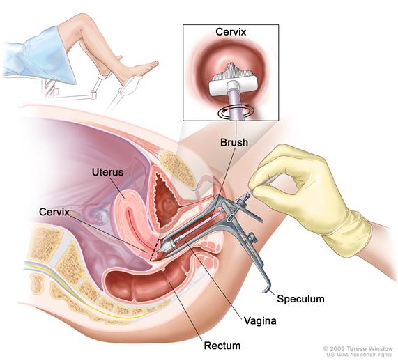 Pap smear; drawing shows a side view of the female reproductive anatomy during a Pap test. A speculum is shown widening the opening of the vagina. A brush is shown inserted into the open vagina and touching the cervix at the base of the uterus. The rectum is also shown. One inset shows the brush touching the center of the cervix. A second inset shows a woman covered by a drape on an exam table with her legs apart and her feet in stirrups.