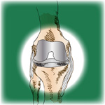 Black/White Disparity in Knee Replacements