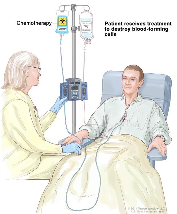 Drawing of a health care provider giving a patient treatment to kill blood-forming cells. Chemotherapy is given to the patient through a catheter in the chest.