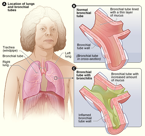 Figure A shows the location of the lungs and bronchial tubes in the body. Figure B is an enlarged, detailed view of a normal bronchial tube. Figure C is an enlarged, detailed view of a bronchial tube with bronchitis. The tube is inflamed and contains more mucus than usual. 