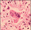 Histopathology of measles pneumonia, (Giant cell with intracytoplasmic inclusions.) 