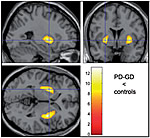 PET scan