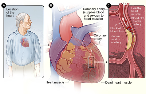 Figure A shows the location of the heart in the body. Figure B is an overview of a heart and coronary artery showing damage (dead heart muscle) caused by a heart attack. Figure C is a cross-section of the coronary artery with plaque buildup and a blood clot.