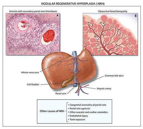 Venopathy as a potential cause of Nodular Regenerative Hyperplasia