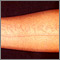 Dermatographism - arm