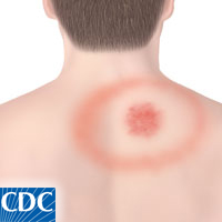 medical illustration of Erythema migrans