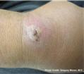 MRSA skin infection
