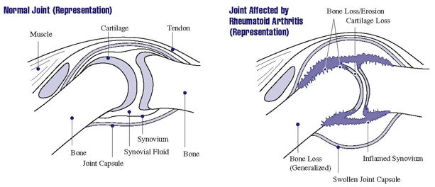 Picture of a Normal Joint and a Joint affected by Rheumatoid Arthritis