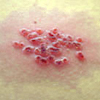 varicella zoster blisters