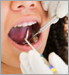 bpa dental sealants