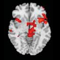 anterior cingulate cortex in hoarders