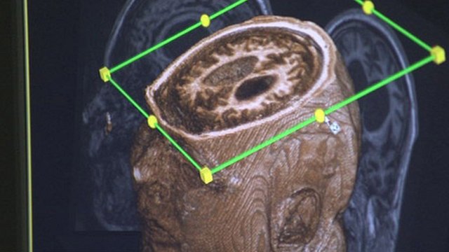 Scan of patient's brain in scanner