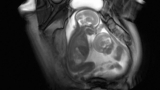 MRI Images Show Unique Slice of Twins' Life