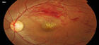 branch retinal vein occlusion